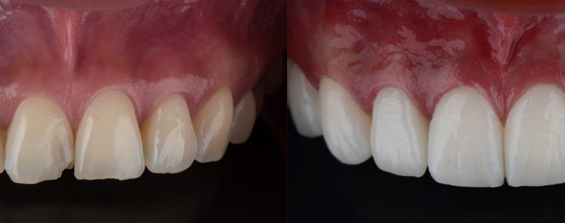 Full,Mouth,Smile,Makeover,With,Dental,Ceramic,Veneers,Treatment,,Present