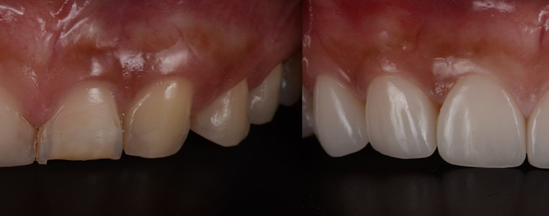 Dental,Veneer,Before,And,After.,Smile,Makeover,With,Dental,Ceramic