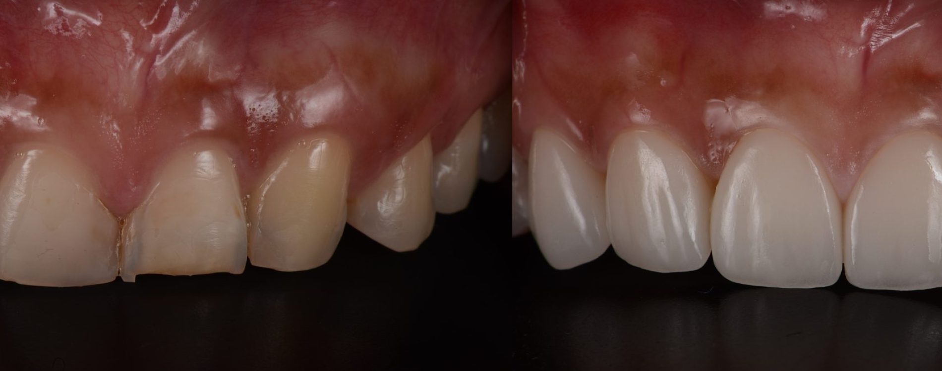 Dental,Veneer,Before,And,After.,Smile,Makeover,With,Dental,Ceramic