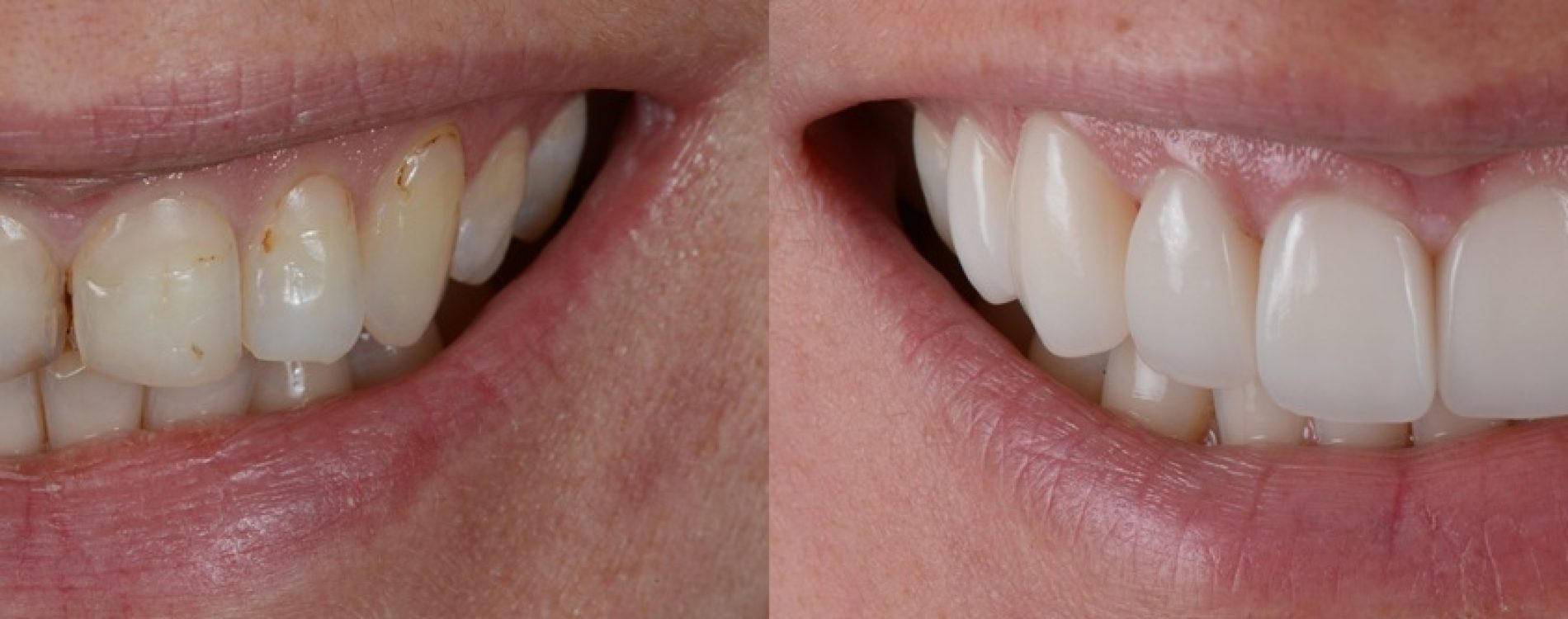 Smile,Makeover,With,Porcelain,Laminated,Veneers,,Before,And,After.