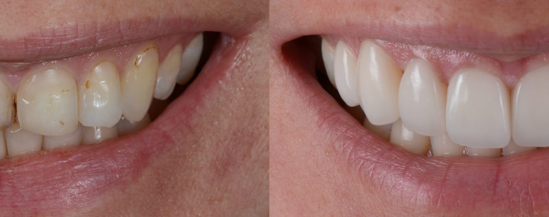 Smile,Makeover,With,Porcelain,Laminated,Veneers,,Before,And,After.