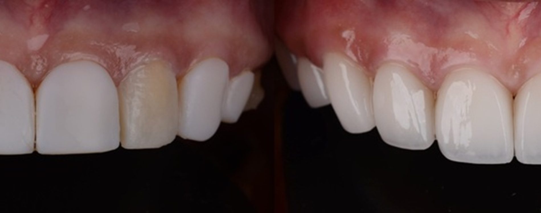 Before,And,After,Of,Changing,Poor,Quality,Veneers,To,High