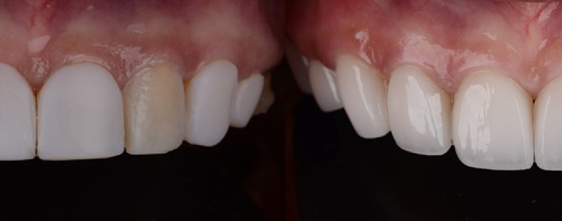 Before,And,After,Of,Changing,Poor,Quality,Veneers,To,High