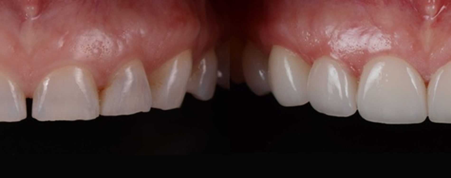 Space,Closure,,,Whitening,And,Reshape,All,Front,Teeth,With