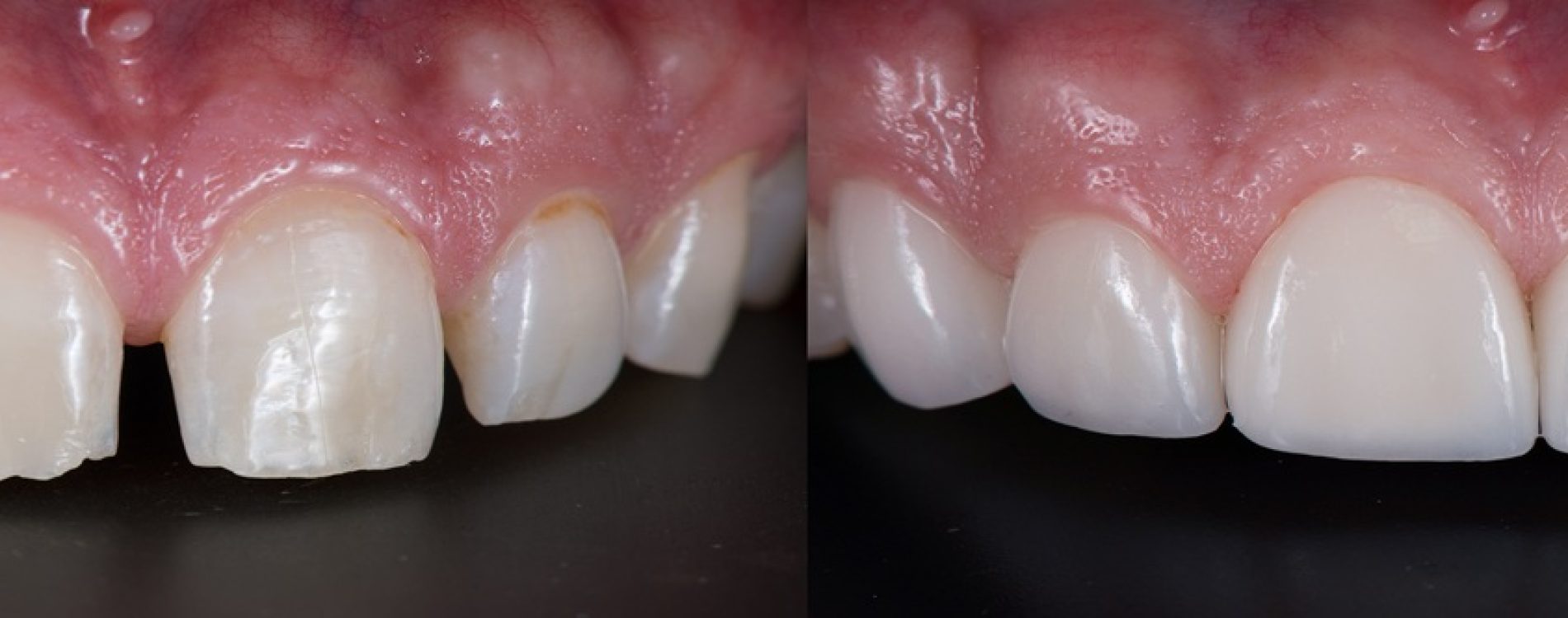 Correction,Of,Spacing,Teeth,With,Dental,Ceramic,Veneers,,Before,And