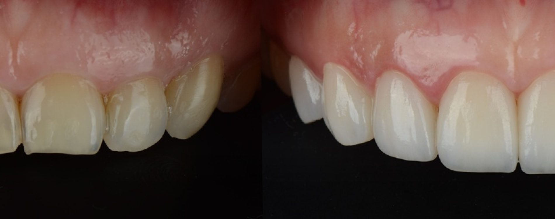 8,Pressed,Ceramic,Veneer,To,Make,Hollywood,Smile,Or,Smile