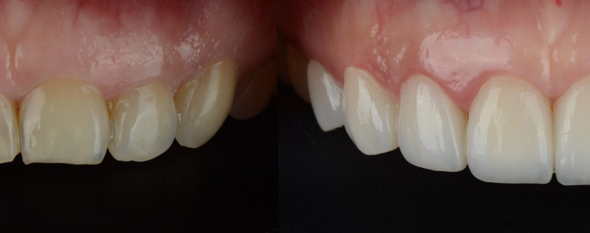8,Pressed,Ceramic,Veneer,To,Make,Hollywood,Smile,Or,Smile