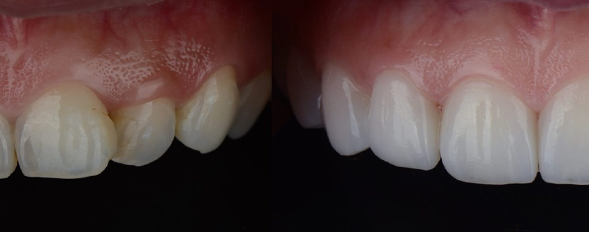 Smile,Makeover,With,Dental,Ceramic,Veneers,Treatment,Treating,Yellow,And