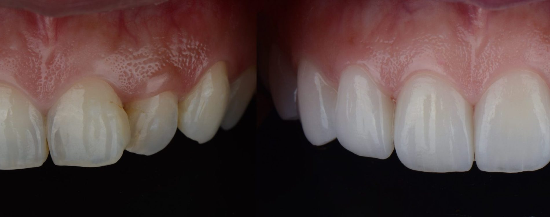 Smile,Makeover,With,Dental,Ceramic,Veneers,Treatment,Treating,Yellow,And